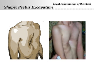 Page  6
Shape: Pectus ExcavatumShape: Pectus Excavatum
Local Examination of the ChestLocal Examination of the Chest
 