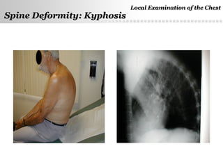 Page  7
Spine Deformity: KyphosisSpine Deformity: Kyphosis
Local Examination of the ChestLocal Examination of the Chest
 