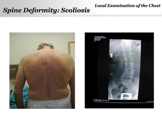Page  8
Spine Deformity: ScoliosisSpine Deformity: Scoliosis
Local Examination of the ChestLocal Examination of the Chest
 