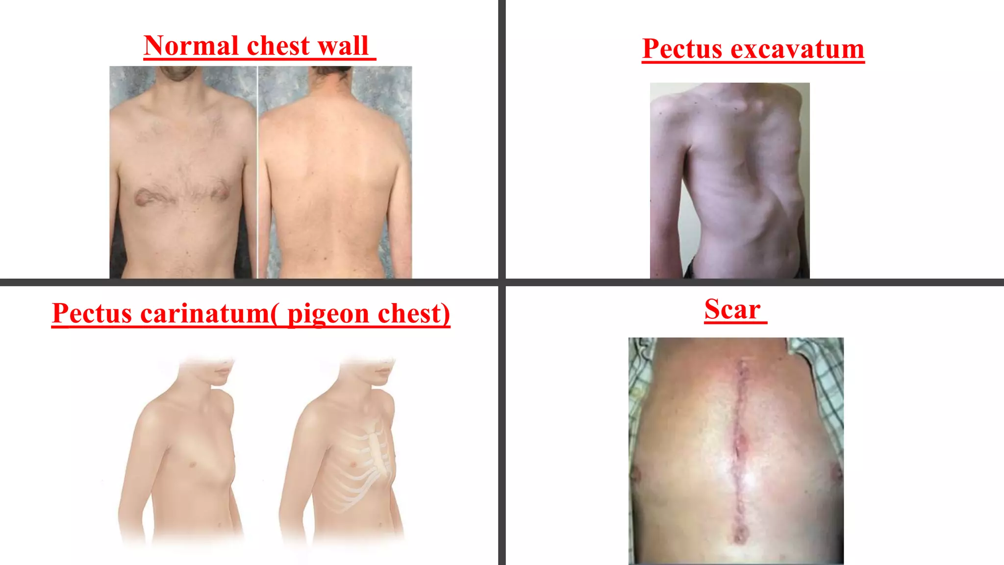 Local chest examination | PPTX