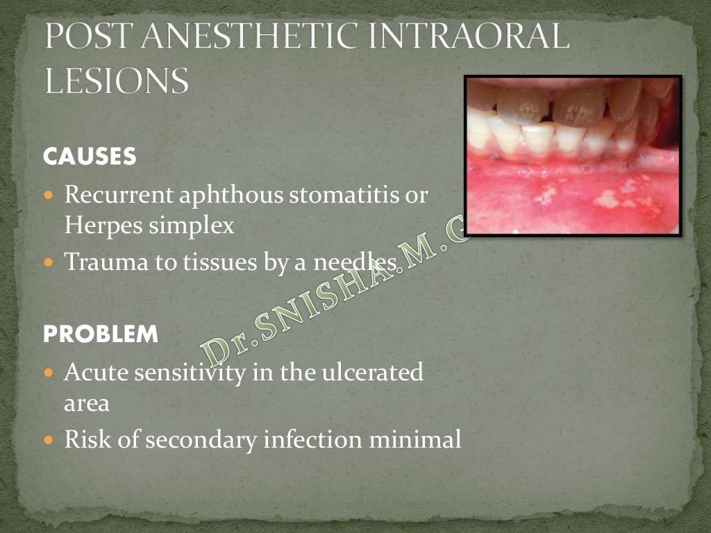 Local complications of Local Anesthesia