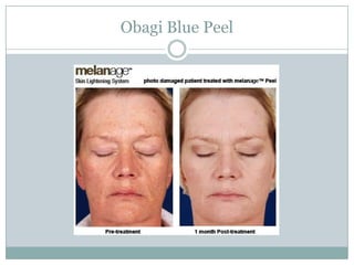 Obagi Blue Peel