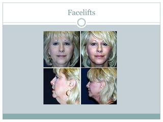 Facelifts