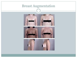 Breast Augmentation
