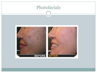 Photofacials