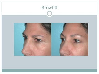 Browlift