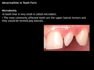 Micro Tooth Local / Dental causes of Malocclusion | PDF
