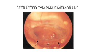 Retracted Local examination of ear in a case of mucosal com.pptx