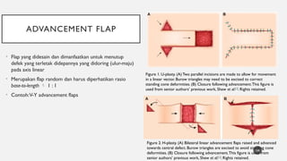 local flap definition and classification.pptx