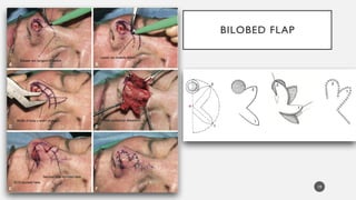 local flap definition and classification.pptx
