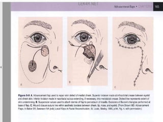 Local flaps classifications | PPTX