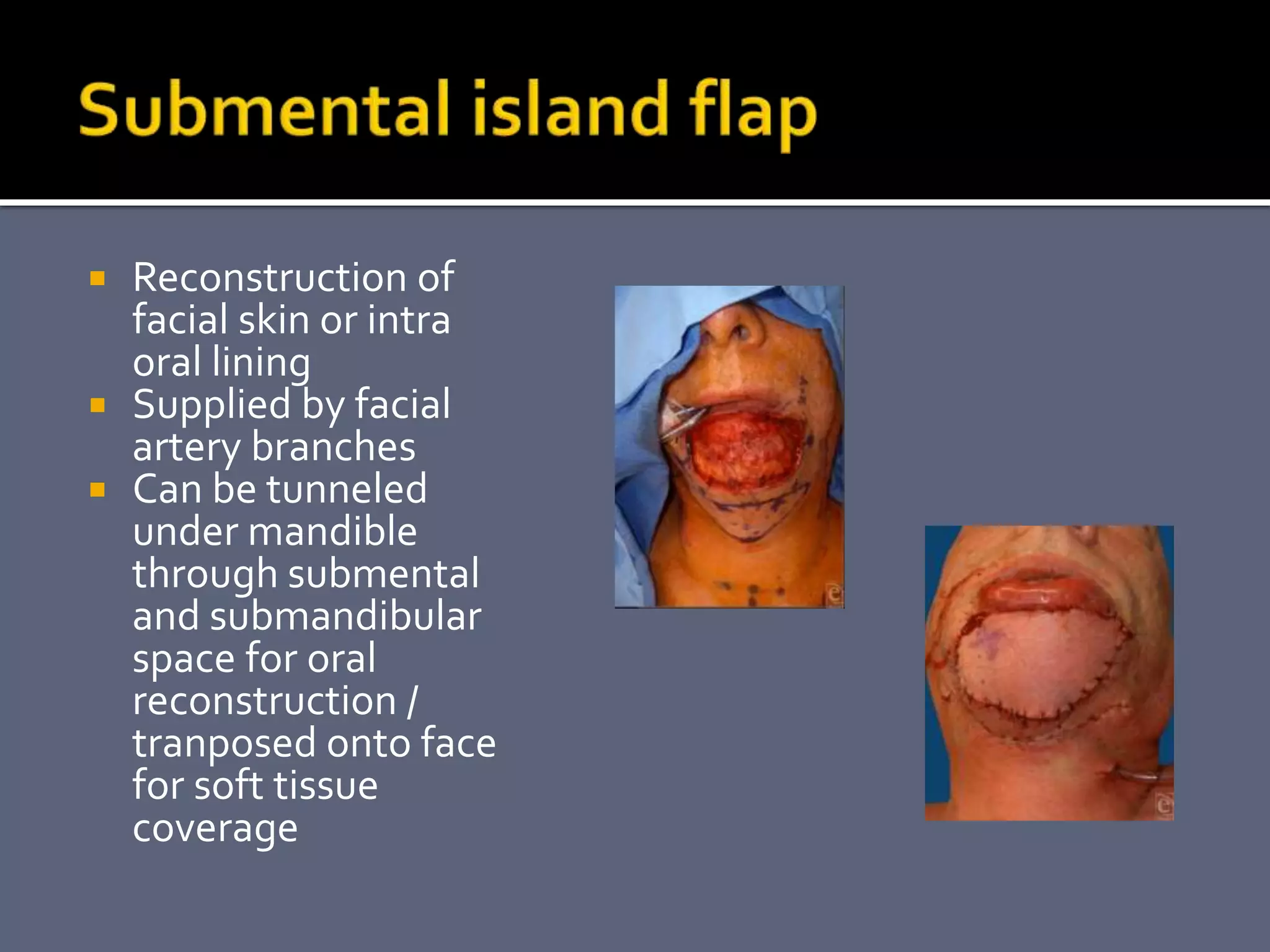 Local flaps in ent | PPTX