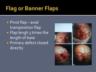  Pivot flap – axial
transposition flap
 Flap lengh 3 times the
length of base
 Primary defect closed
directly
 