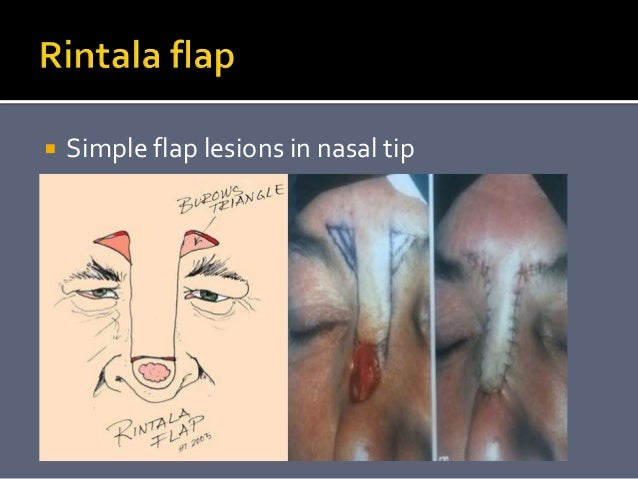 Local flaps in ent