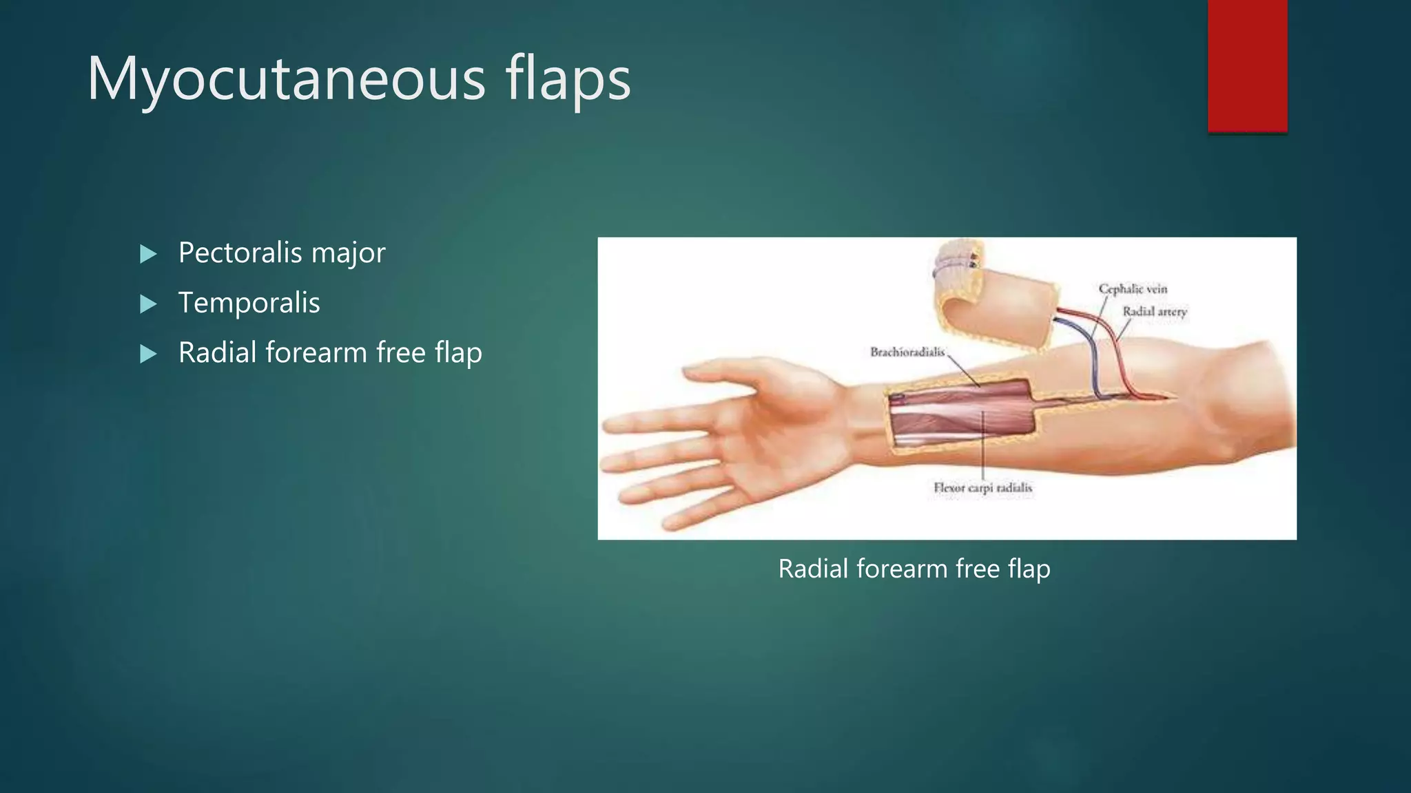 Myocutaneous flaps
 Pectoralis major
 Temporalis
 Radial forearm free flap
Radial forearm free flap
 