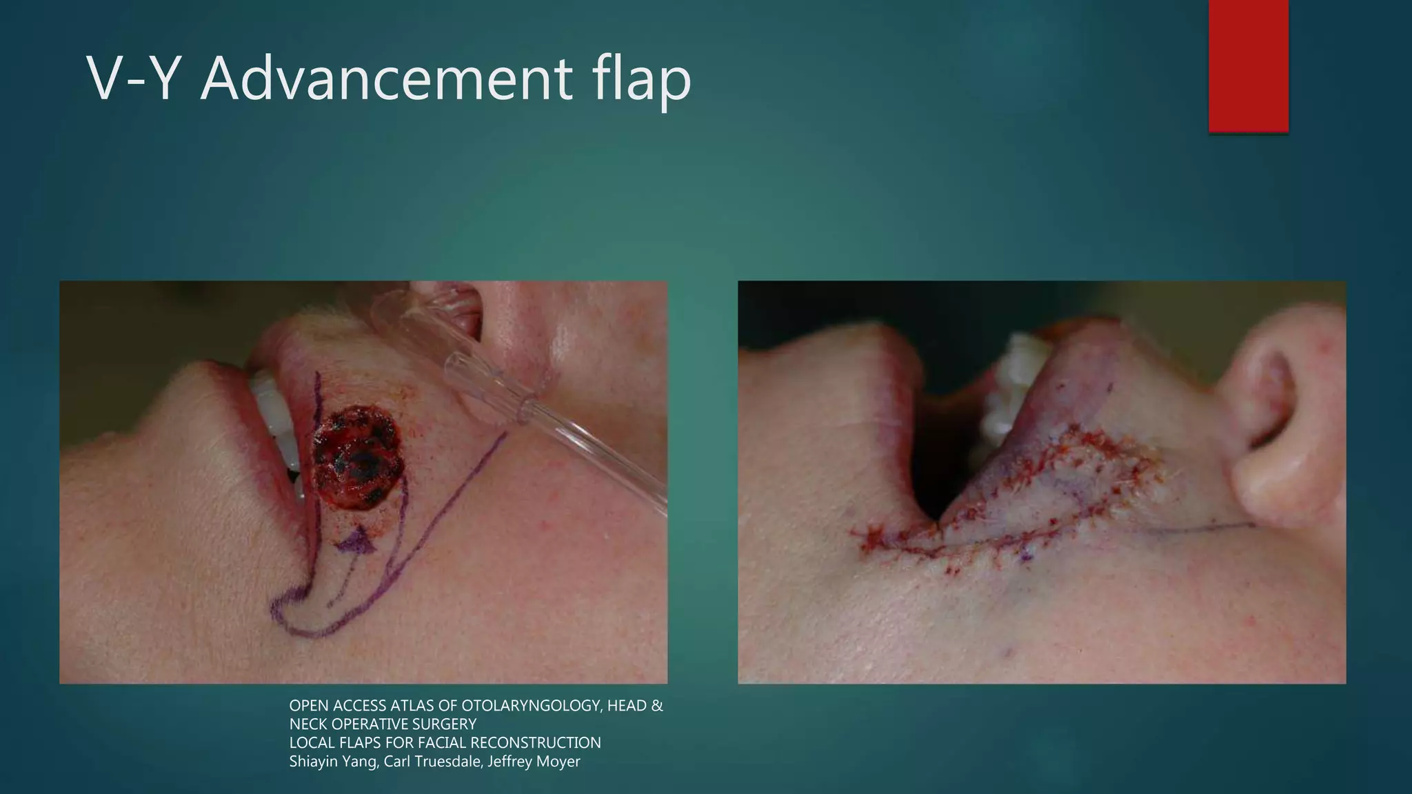 V-Y Advancement flap
OPEN ACCESS ATLAS OF OTOLARYNGOLOGY, HEAD &
NECK OPERATIVE SURGERY
LOCAL FLAPS FOR FACIAL RECONSTRUCTION
Shiayin Yang, Carl Truesdale, Jeffrey Moyer
 