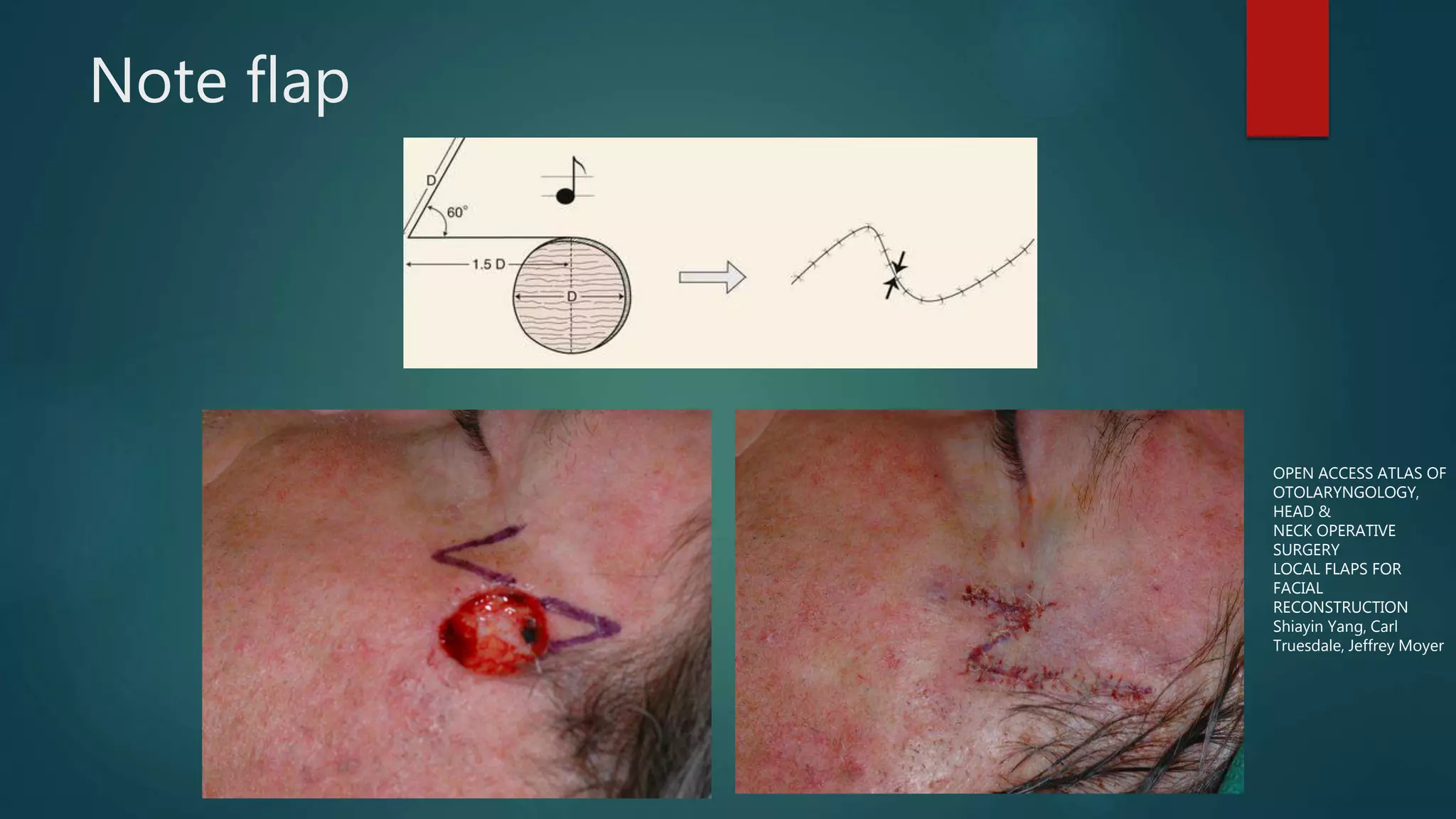 Note flap
OPEN ACCESS ATLAS OF
OTOLARYNGOLOGY,
HEAD &
NECK OPERATIVE
SURGERY
LOCAL FLAPS FOR
FACIAL
RECONSTRUCTION
Shiayin Yang, Carl
Truesdale, Jeffrey Moyer
 