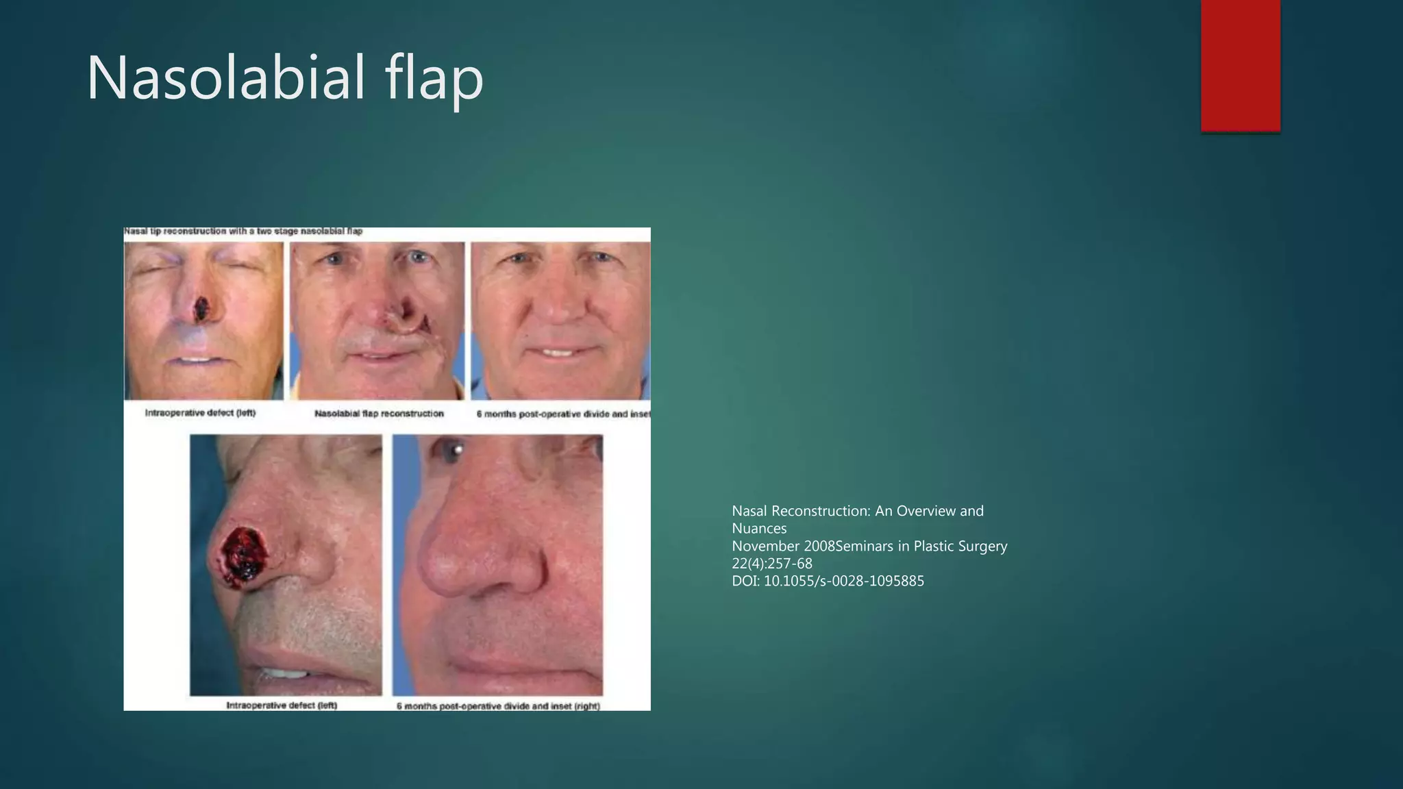 Nasolabial flap
Nasal Reconstruction: An Overview and
Nuances
November 2008Seminars in Plastic Surgery
22(4):257-68
DOI: 10.1055/s-0028-1095885
 