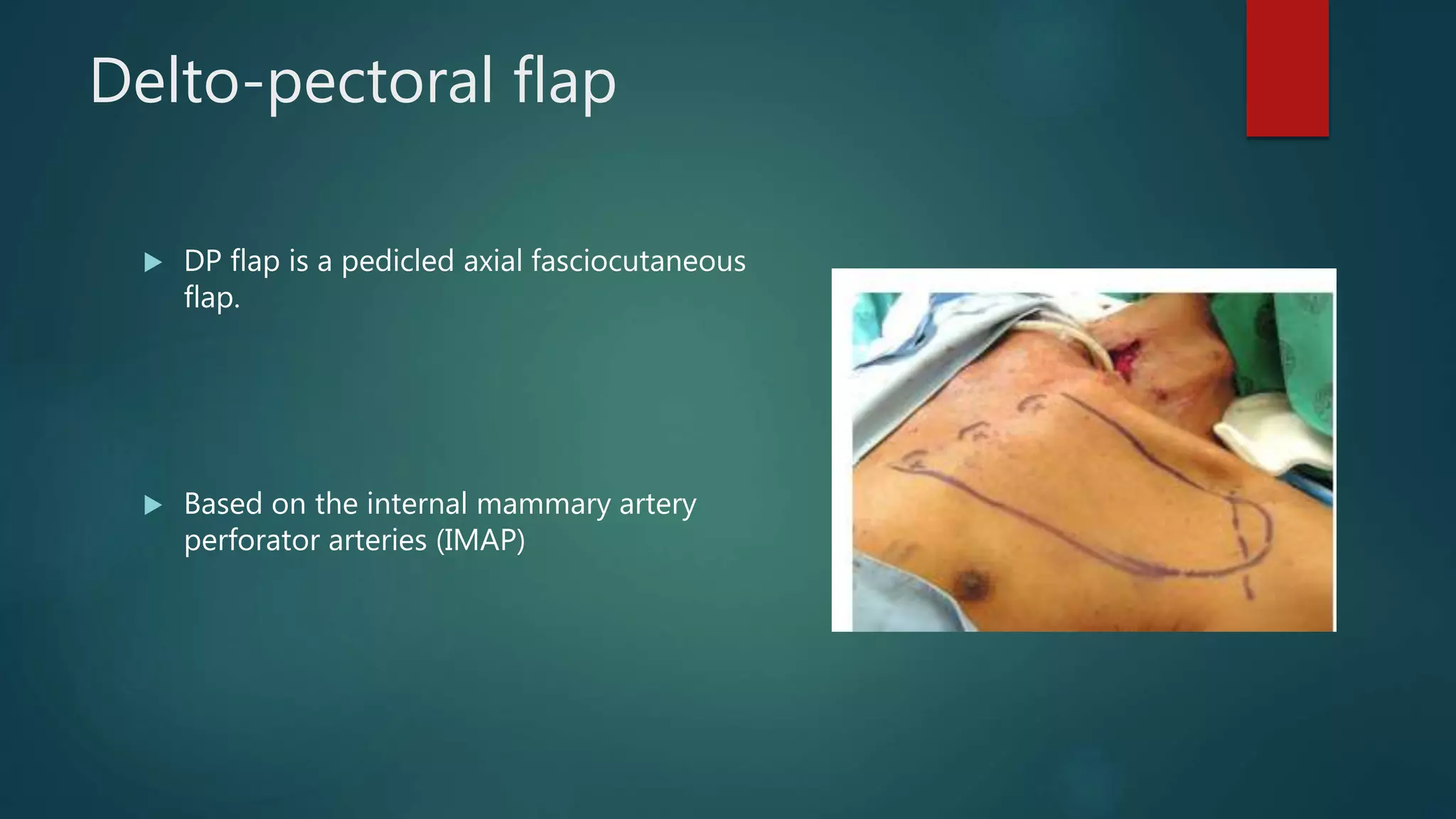 Delto-pectoral flap
 DP flap is a pedicled axial fasciocutaneous
flap.
 Based on the internal mammary artery
perforator arteries (IMAP)
 