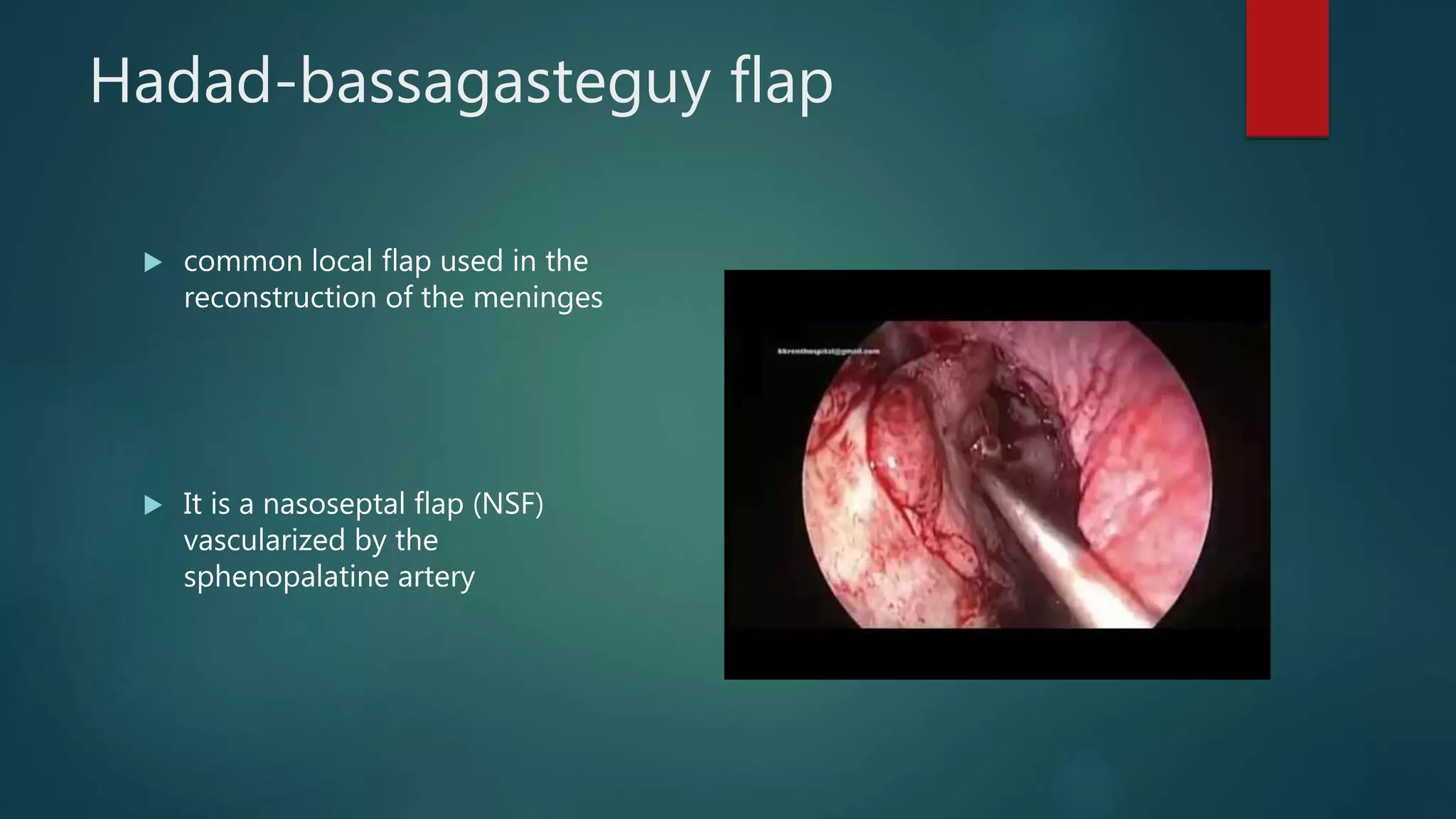 Hadad-bassagasteguy flap
 common local flap used in the
reconstruction of the meninges
 It is a nasoseptal flap (NSF)
vascularized by the
sphenopalatine artery
 