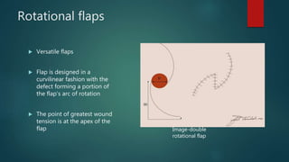 Large Rotation Flap Local flaps in ent | PPTX