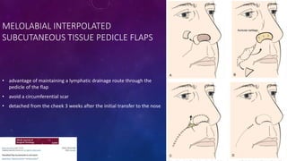 Pedicle Flaps Example local flaps in head and neck surgery -Maroti.pptx
