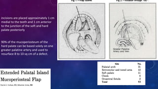local flaps in head and neck surgery -Maroti.pptx