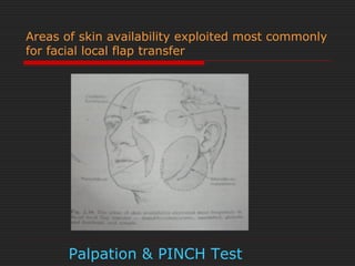 Areas of skin availability exploited most commonly 
for facial local flap transfer 
Palpation & PINCH Test 
 