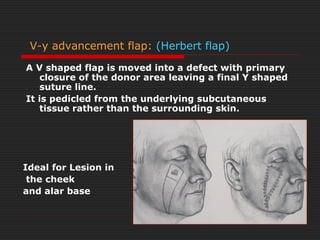 V-y advancement flap: (Herbert flap) 
A V shaped flap is moved into a defect with primary 
closure of the donor area leaving a final Y shaped 
suture line. 
It is pedicled from the underlying subcutaneous 
tissue rather than the surrounding skin. 
Ideal for Lesion in 
the cheek 
and alar base 
 