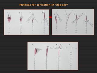Methods for correction of “dog ear” 
 