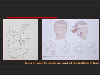 Long enough to reach any part of the ipsilateral face 
 