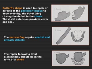 Butterfly shape is used to repair of 
defects of the posterior tongue to 
allow Mobility, the other wing 
closing the defect in the cheek. 
The distal extension provides cover 
and seal. 
The narrow flap repairs central and 
alveolar defects 
The repair following total 
glossectomy should be in the 
form of a shield 
 