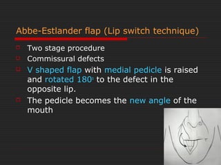 Abbe-Estlander flap (Lip switch technique) 
 Two stage procedure 
 Commissural defects 
 V shaped flap with medial pedicle is raised 
and rotated 180o to the defect in the 
opposite lip. 
 The pedicle becomes the new angle of the 
mouth 
 
