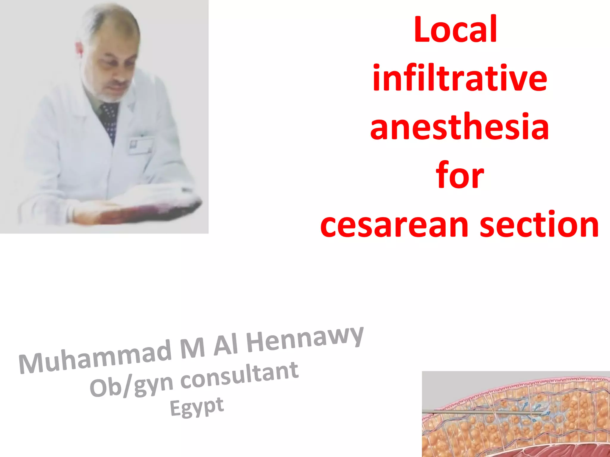 Local infiltrative anesthesia for cesarean section PPT