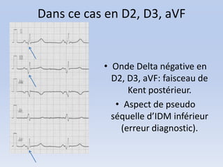 Dans ce cas en D2, D3, aVF


           • Onde Delta négative en
             D2, D3, aVF: faisceau de
                 Kent postérieur.
              • Aspect de pseudo
             séquelle d’IDM inférieur
               (erreur diagnostic).
 