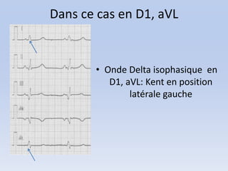 Dans ce cas en D1, aVL


       • Onde Delta isophasique en
          D1, aVL: Kent en position
               latérale gauche
 