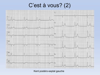 C’est à vous? (2)




  Kent postéro-septal gauche
 