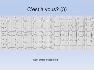 C’est à vous? (3)




  Kent antéro-septal droit.
 