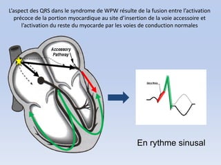 L’aspect des QRS dans le syndrome de WPW résulte de la fusion entre l’activation
   précoce de la portion myocardique au site d’insertion de la voie accessoire et
      l’activation du reste du myocarde par les voies de conduction normales




                                                   En rythme sinusal
 