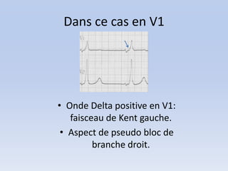 Dans ce cas en V1




• Onde Delta positive en V1:
   faisceau de Kent gauche.
 • Aspect de pseudo bloc de
         branche droit.
 