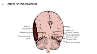 A. LATERAL (UNCAL) HERNIATION
 