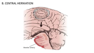B. CENTRAL HERNIATION
 