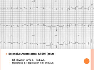 INFERIOR STEMI
 Generally have a more favourable prognosis than
anterior myocardial infarction
 However certain factors ...
