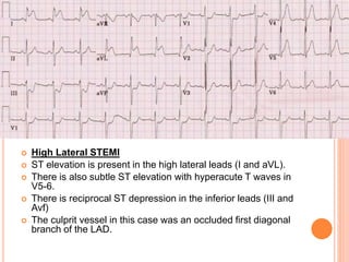 POSTERIOR MI IS SUGGESTED BY THE
FOLLOWING CHANGES IN V1-3:
 Horizontal ST depression
 Tall, broad R waves (>30ms)
 Upr...
