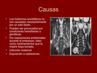 Causas Los trastornos encefálicos no son causados necesariamente por un solo factor.  Pueden ser provocados por condiciones hereditarias o genéticas. Por exposiciones ambientales durante el embarazo, tales como medicamentos que la madre haya tomado.  Infección maternal  Exposición a radiaciones.  