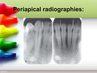 Periapical Radiopacity Classification object Localization in intraoral radiographies | PPTX