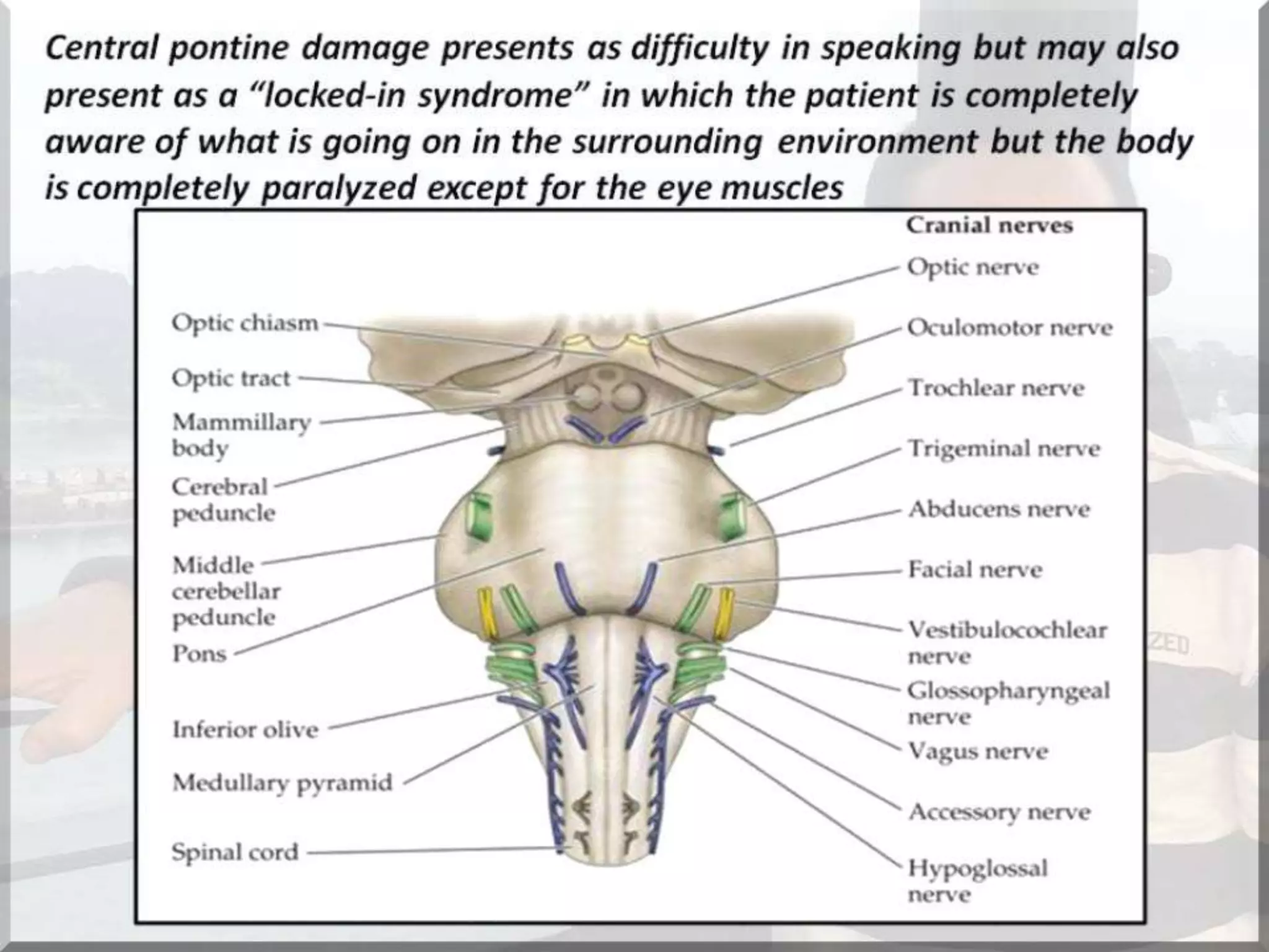 Localization of brainstem lesion by Prof Dr Bashir Ahmed Dar Sopore Kashmir