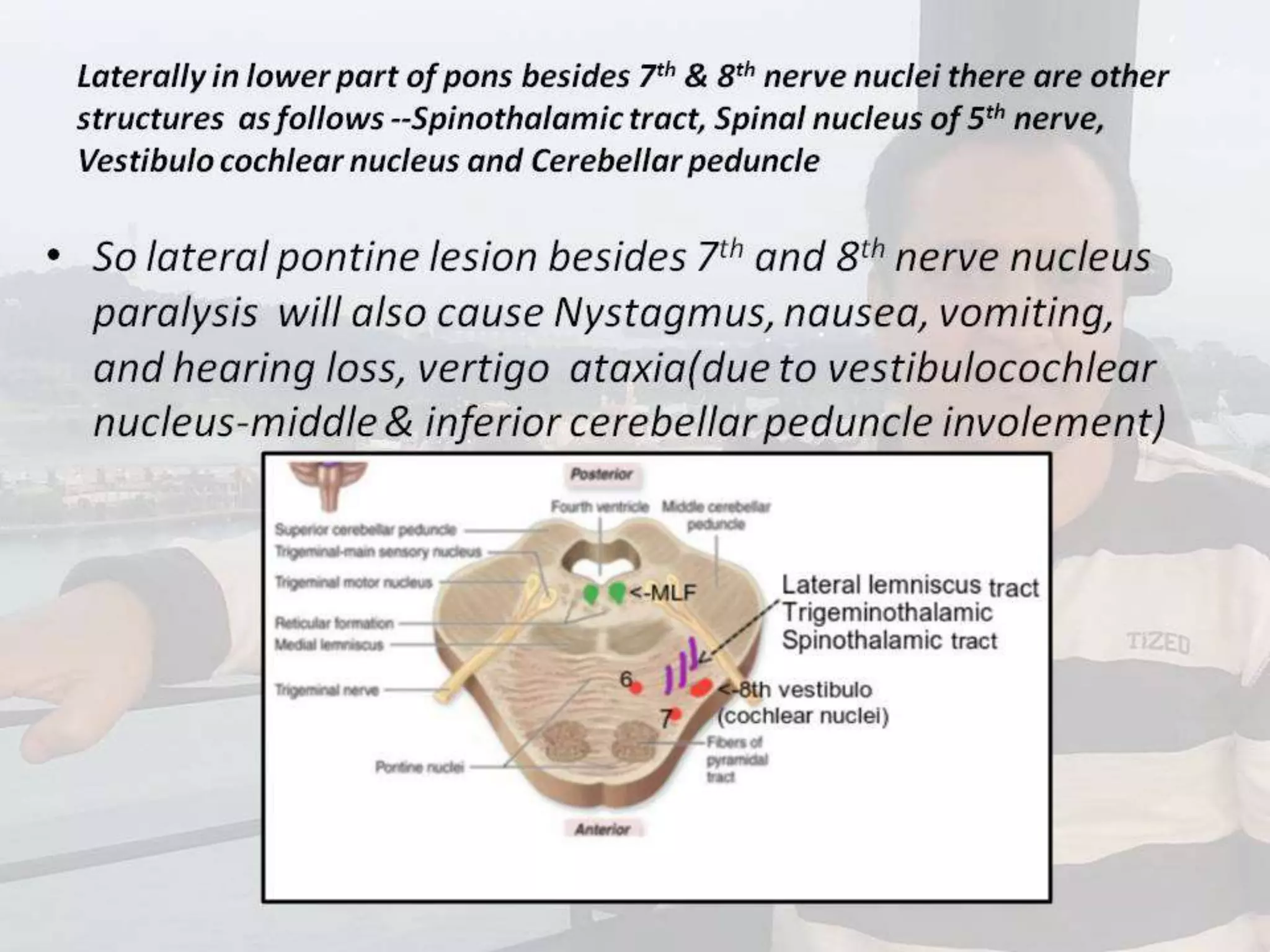 Localization of brainstem lesion by Prof Dr Bashir Ahmed Dar Sopore Kashmir