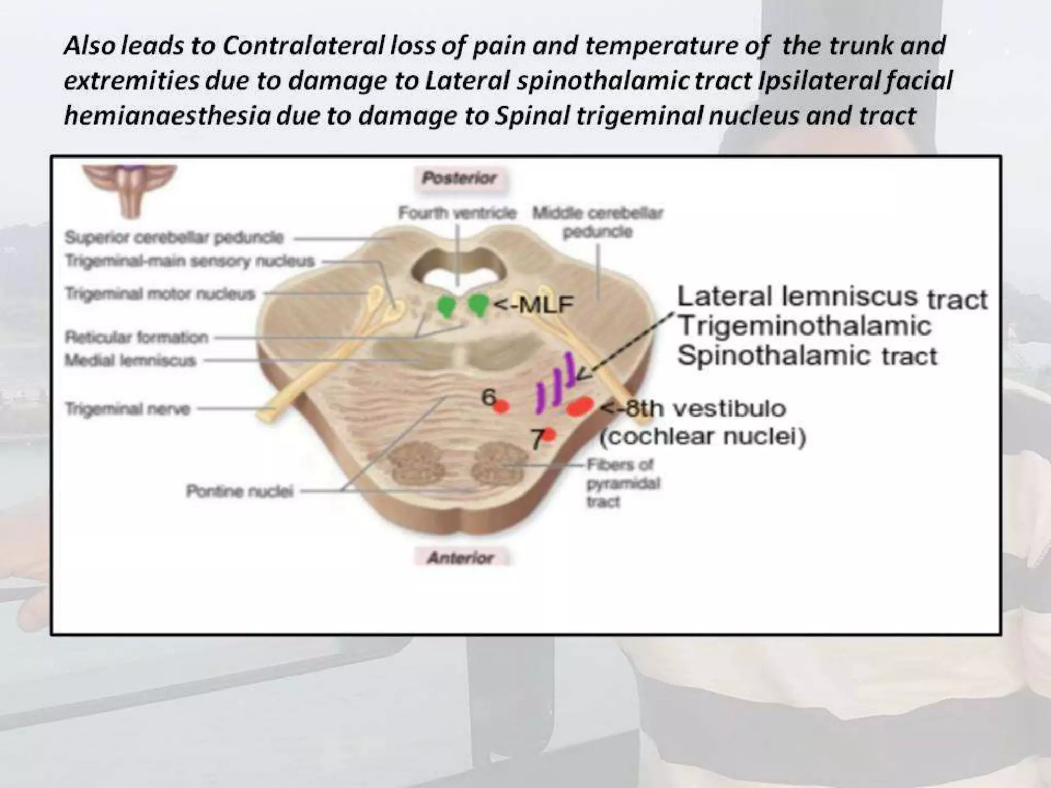 Localization of brainstem lesion by Prof Dr Bashir Ahmed Dar Sopore Kashmir