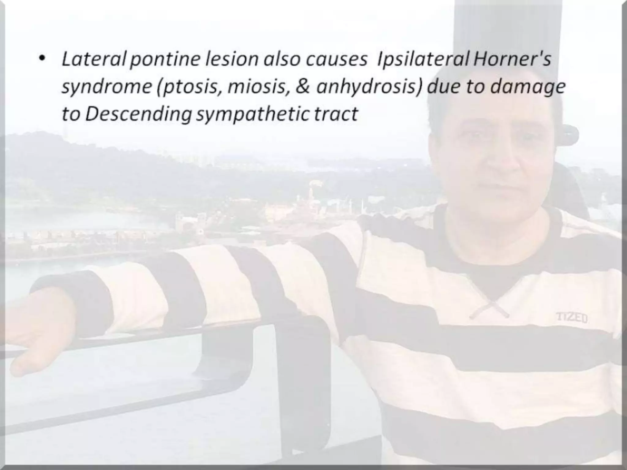 Localization of brainstem lesion by Prof Dr Bashir Ahmed Dar Sopore Kashmir